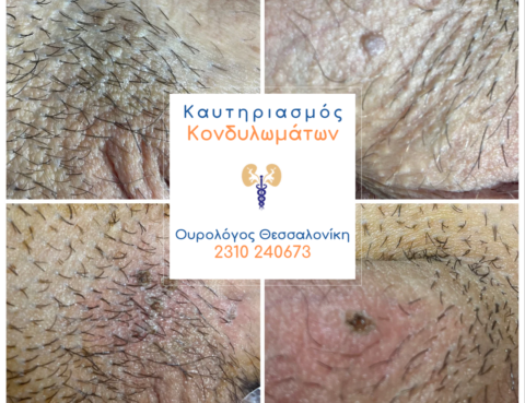 Καυτηριασμός κονδυλωμάτων