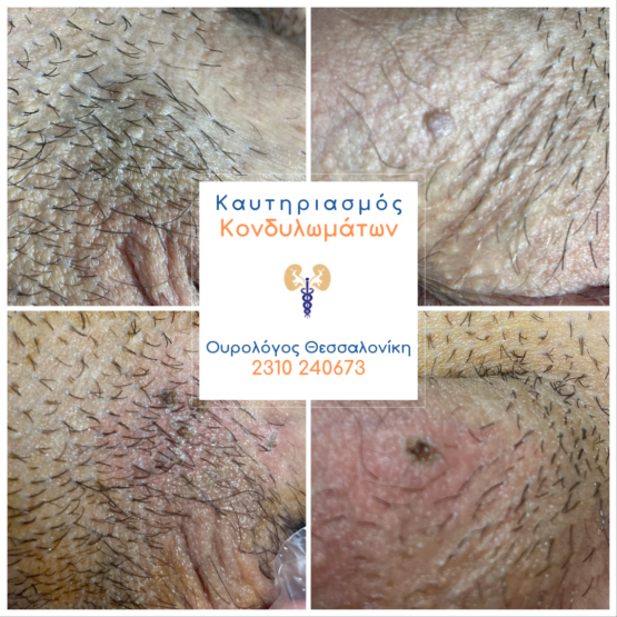 Καυτηριασμός κονδυλωμάτων