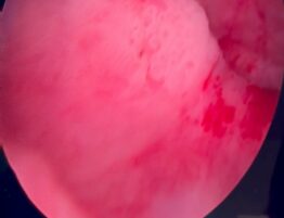 karkinoma_ourodoxou_kysteos-eikona