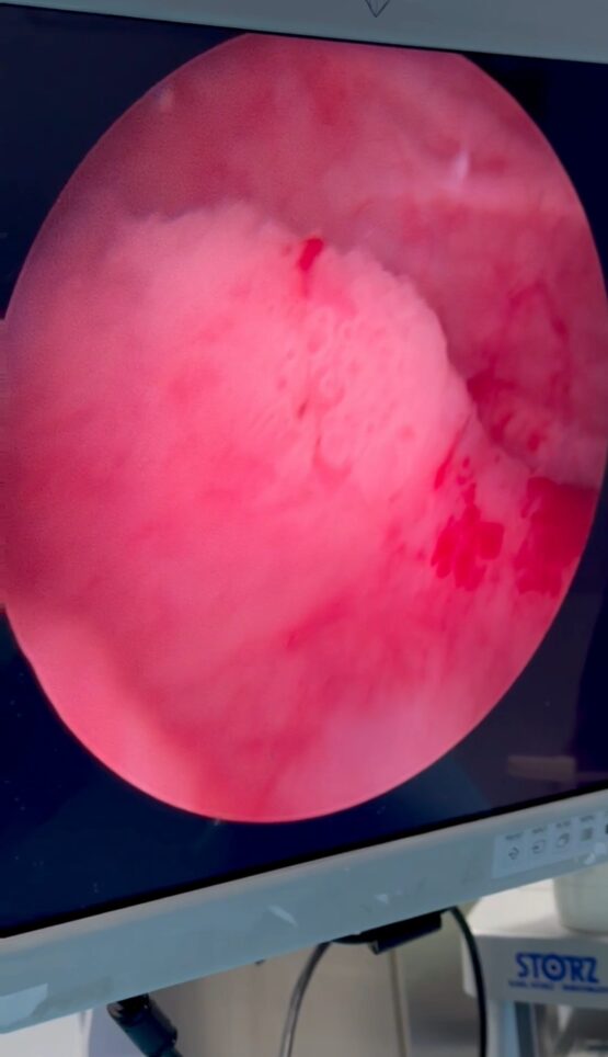 karkinoma_ourodoxou_kysteos-eikona